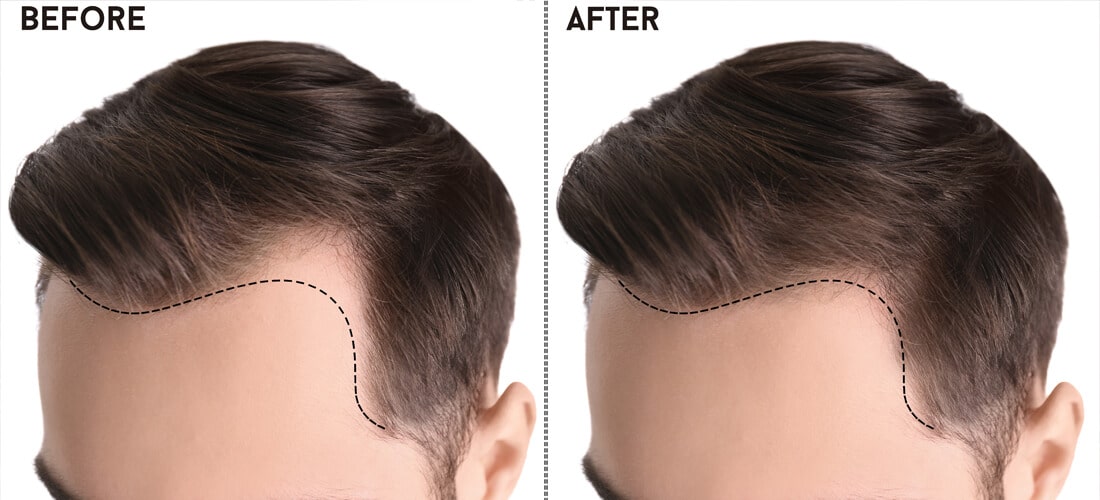 Unlocking Confidence: Discovering the Best Hair Transplant in Islamabad with Hair n Hair