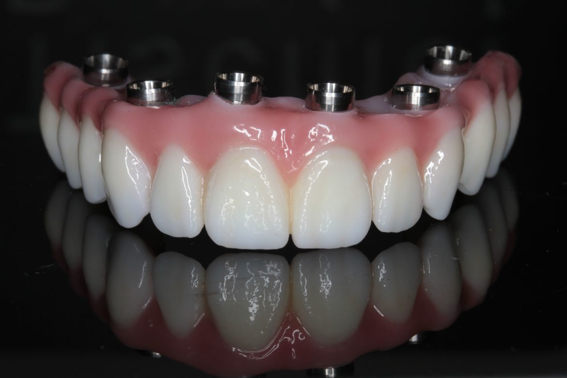 Advanced Custom Crown and Bridge Solutions for Superior Dental Care