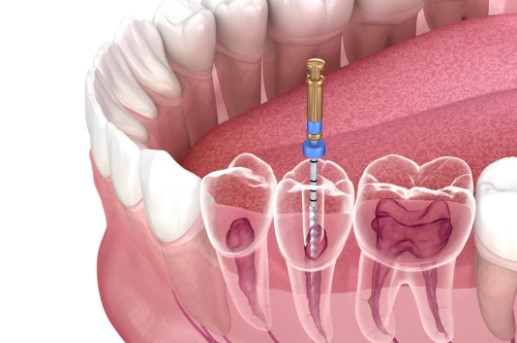 Root Canal Treatment Penrith