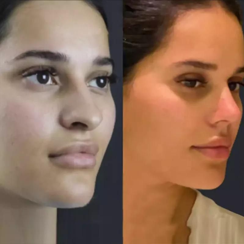 The Psychology of Rhinoplasty: Understanding the Emotional Journey in Dubai